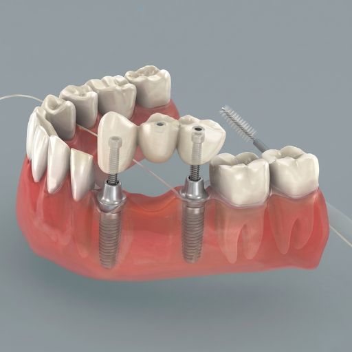 Tooth Fixation Using Screws (Implant)
