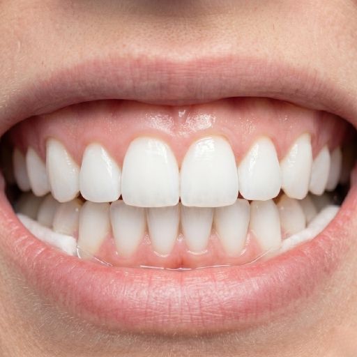 Tooth Whitening